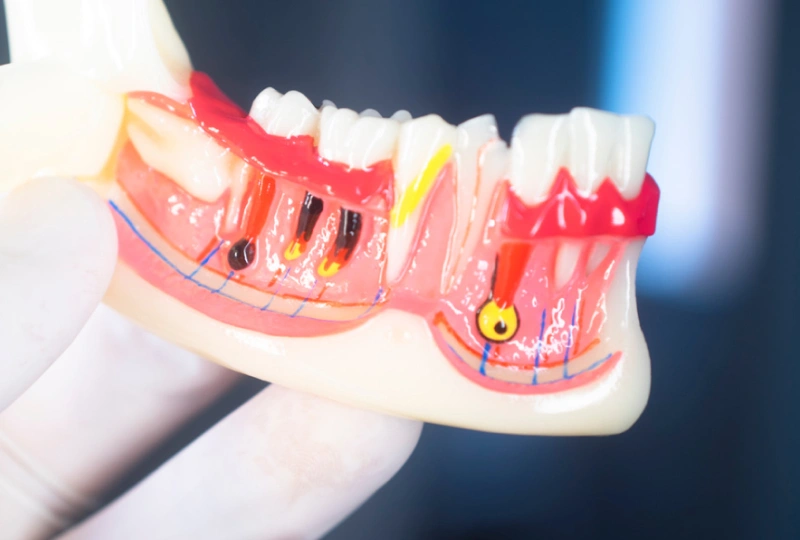Apicoectomy in The Woodlands, TX | Dentistry and Orthodontics