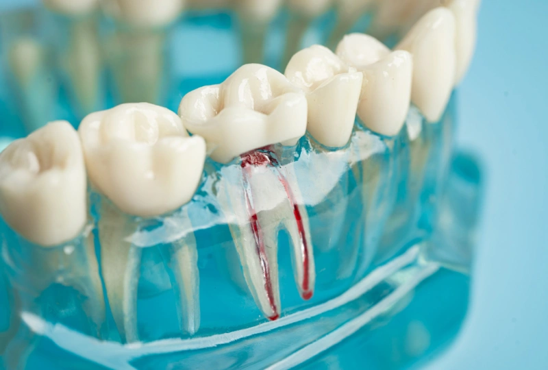 Root Apicoectomy Apicoectomy in The Woodlands, TX | Dentistry and Orthodontics